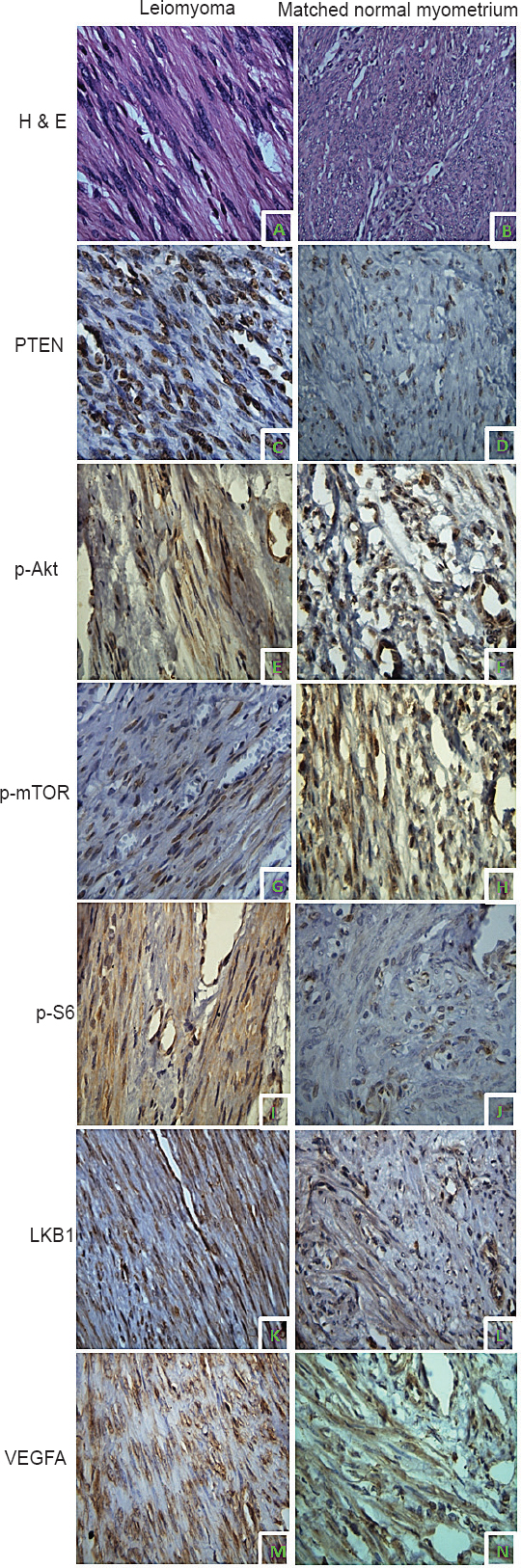 Immunolocalization PI3K/Akt/mTOR pathway proteins in uterine leiomyoma (UL) and matched myometrium (MM). Hematoxylin and Eosin (H&E) stained section of UL (A) and MM (B). Phosphatase and tensin homolog deleted on chromosome ten (PTEN) expression in UL (C) and MM (D). pAkt expression in UL (E) and MM (F). Mammalian target of rapamycin phosphorylated at serine 2448 (p-mTOR) expression in UL (G) and MM (H). S6 ribosomal protein phosphorylated at serine 235/236 (pS6) expression in UL (I) and MM (J). liver kinase B1 (LKB1) expression in UL (K) and MM (L). Vascular endothelial growth factor A (VEGFA) expression in UL (M) and MM (N). Except for panel B (20x magnification), images in all other panels are captured with 40x magnification.